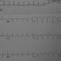 ecg_wpw_postreversion.jpg